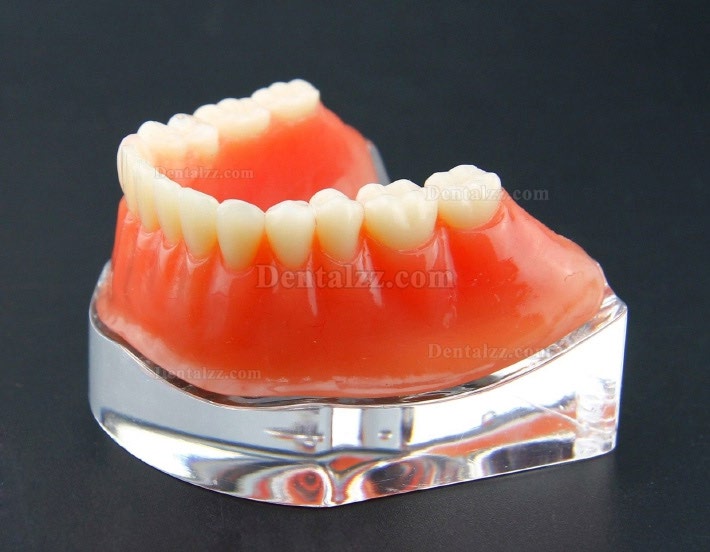 歯科用オーバーデンチャー歯モデル下顎精密インプラントモデル金色